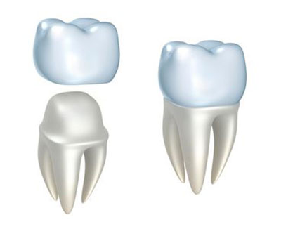 diagram of a dental crown being placed