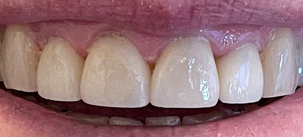 After image